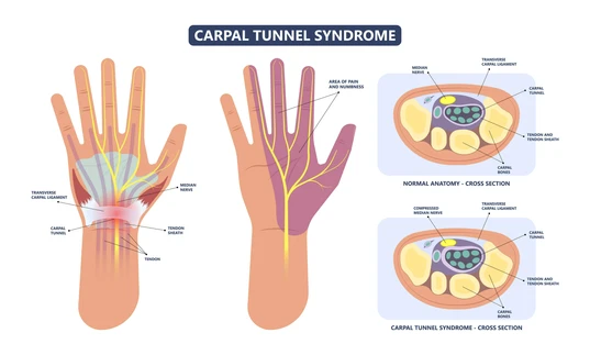 Carpal tunnel graphic